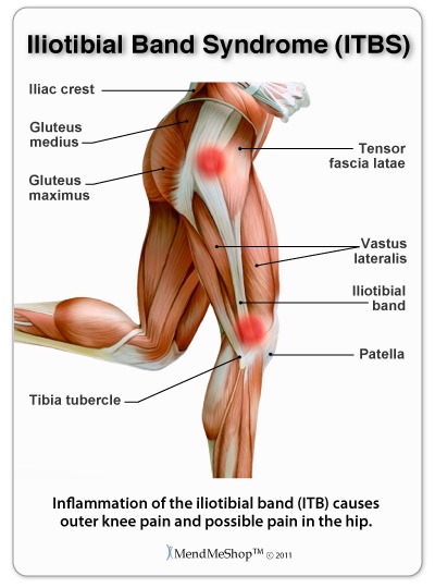 ITBS causes and symptoms